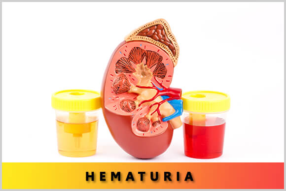 Hematuria, All You Need To Know About