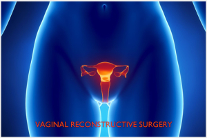 Vaginal Reconstructive Surgery Image