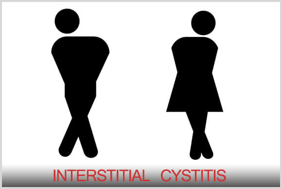 Interstitial Cystitis