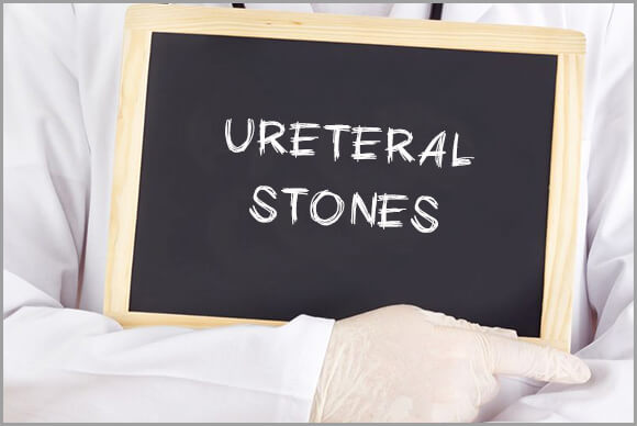 Ureteral Stones | Diagnosis | Treatment