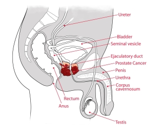 PSA Screening Diagram Info.