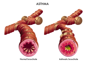 Asthma Image