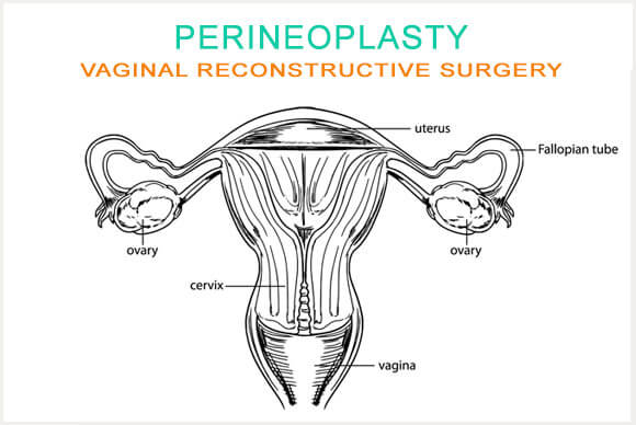 What is Perineoplasty?