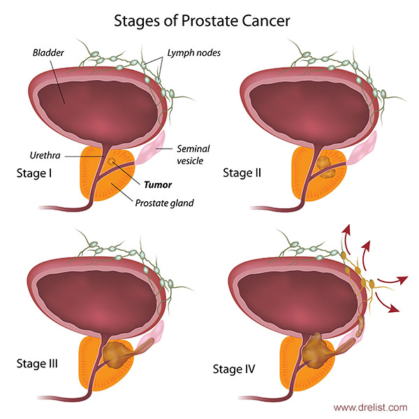 prostate cancer stages image