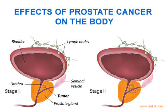 Effects of Prostate Cancer on the Body