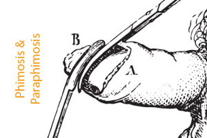 Phimosis and Paraphimosis Image