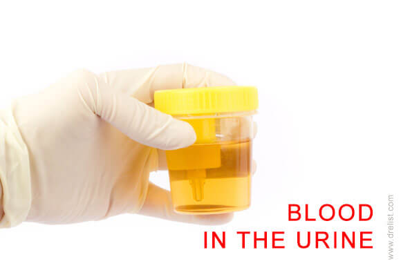 Blood in the Urine