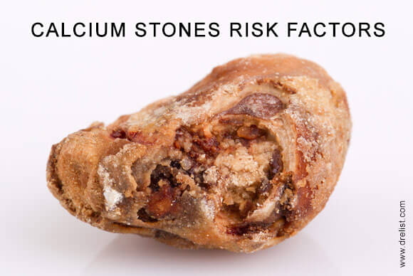 Risk Factors for Calcium Stones