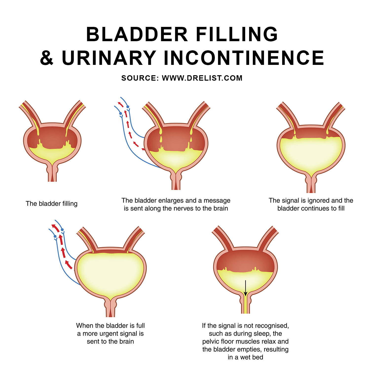 Urinary Incontinence Image