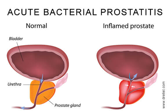 Acute Bacterial Prostatitis