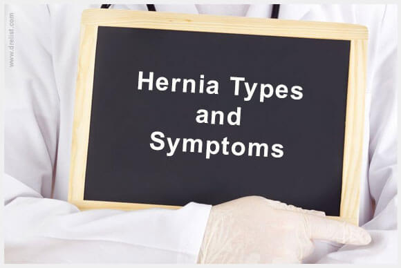 Hernia Types and Symptoms