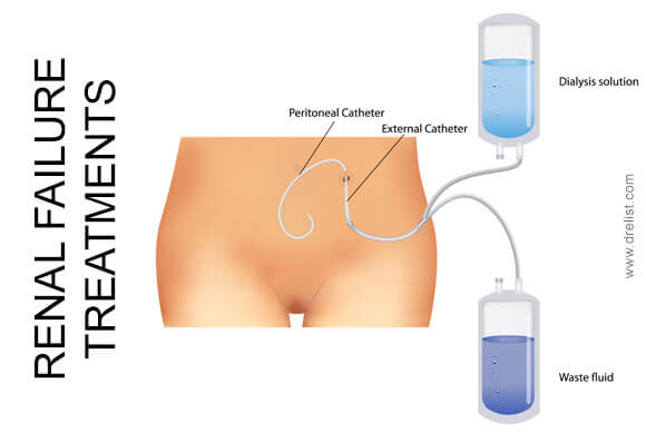 Renal Failure Treatments