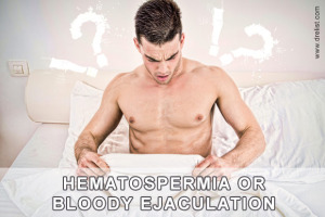Hematospermia Image