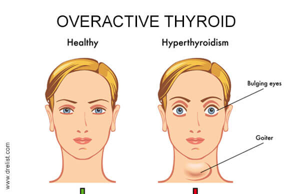 Overactive Thyroid | Hyperthyroidism