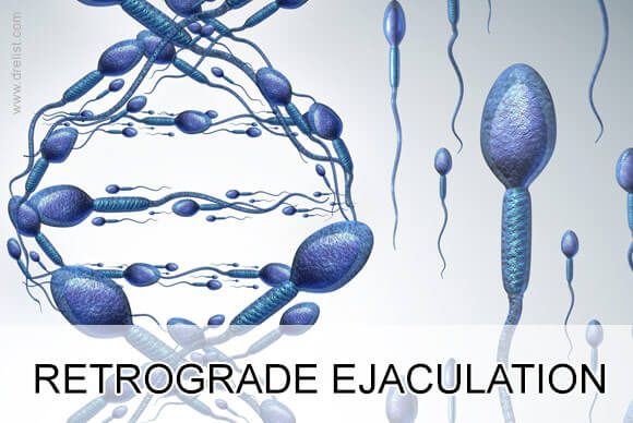 Retrograde Ejaculation