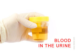 Blood in the Urine image
