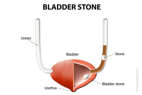 Bladder Stones Symptom, Diagnosis and Treatment