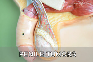 Penile Tumors Image
