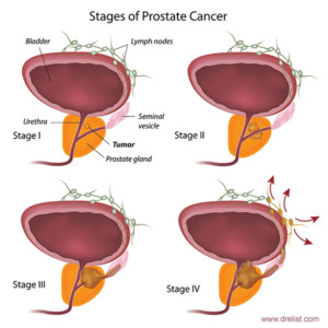 prostate cancer stages image