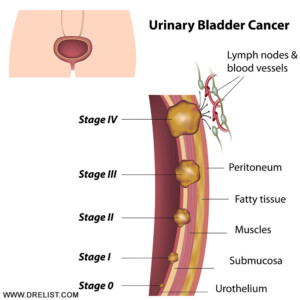 Bladder Cancer Stages Image