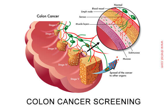 Colon Cancer Screening