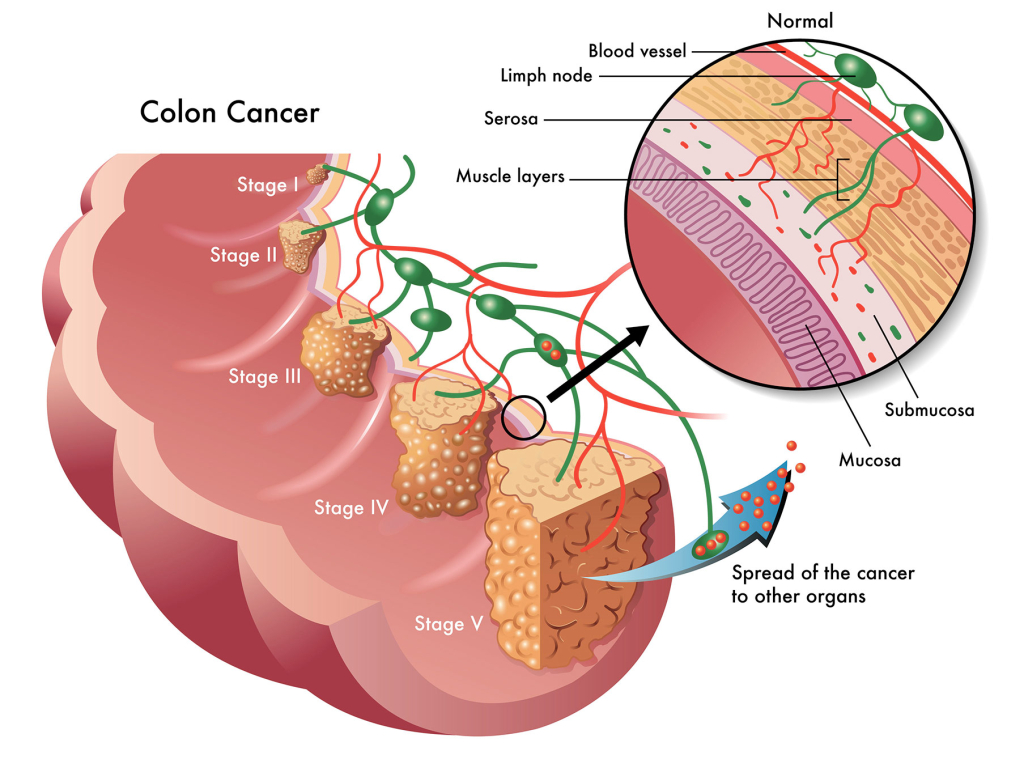 Colon Cancer Screening Image