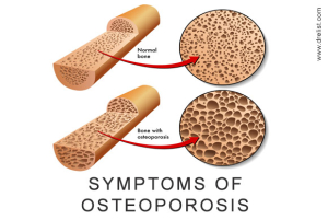 Symptoms of Osteoporosis Image
