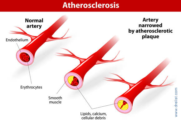 What Is Atherosclerosis?