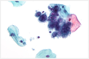 What is STD? Cause: Viruses