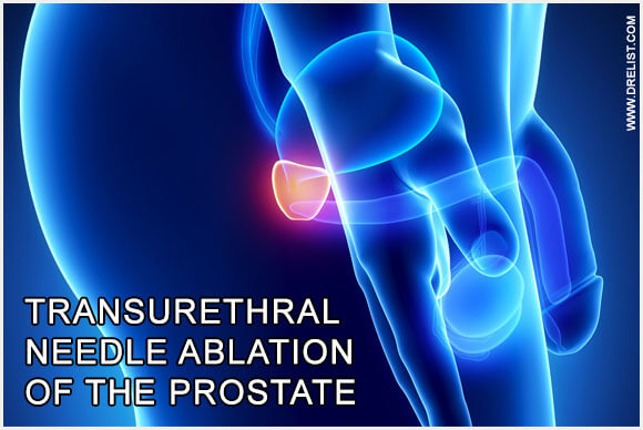 Transurethral Needle Ablation of the Prostate