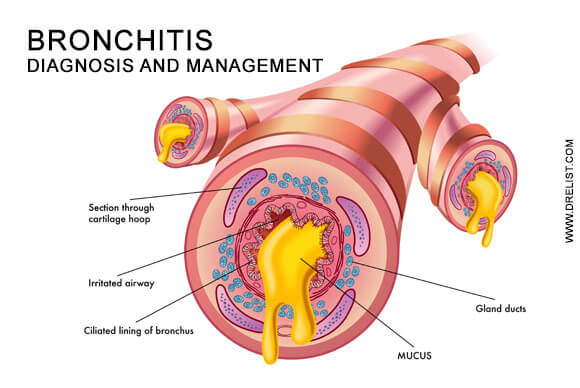 Bronchitis Diagnosis and Management