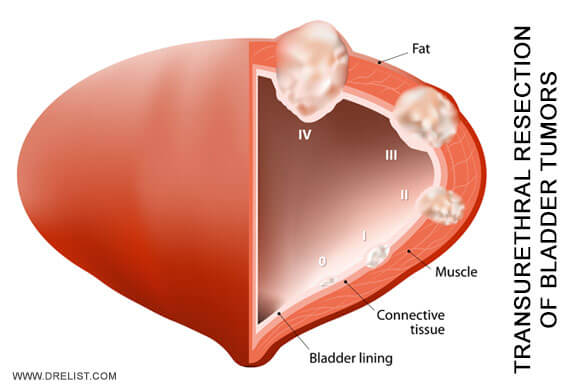 Transurethral Resection of Bladder Tumors
