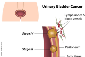 Bladder Cancer image