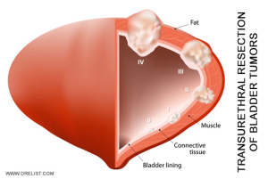 Bladder Tumors Image