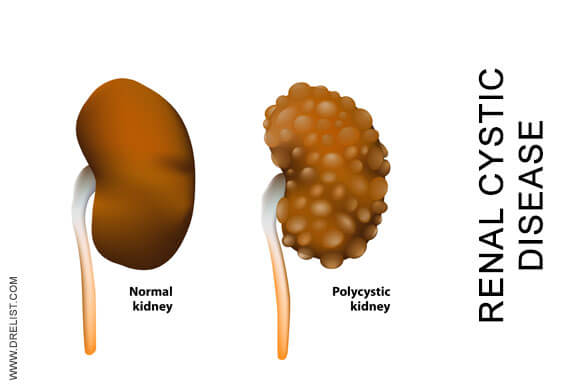 Renal Cystic Disease