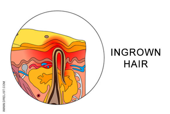 Ingrown Hair