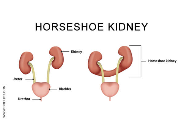 Horseshoe Kidney