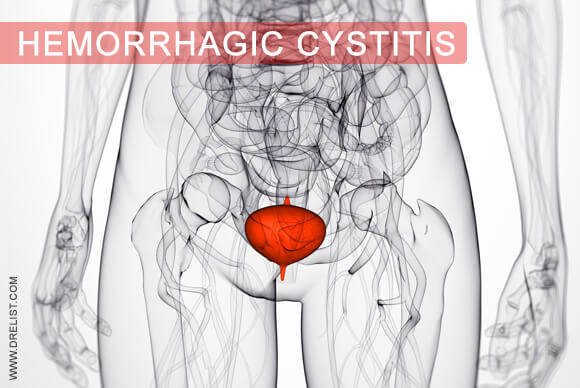 Hemorrhagic Cystitis