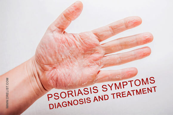 Psoriasis Symptoms | Diagnosis and Treatment