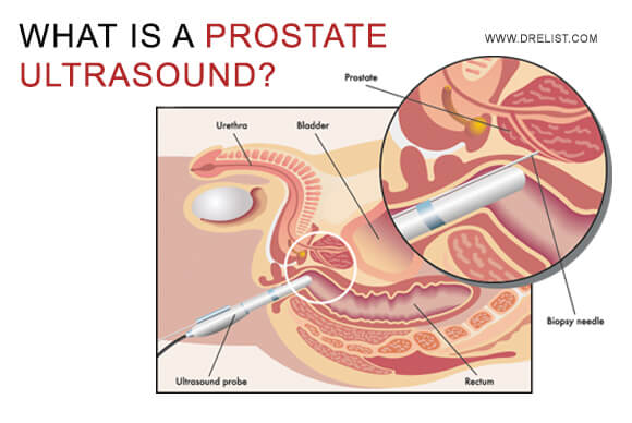 What Is A Prostate Ultrasound?