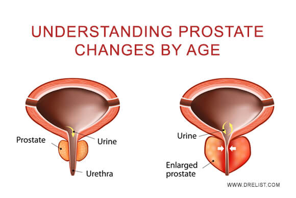 Understanding Prostate Changes by Age