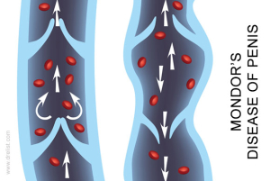 Mondor’s Disease Image