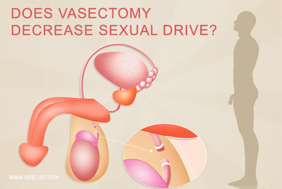 Does Vasectomy decrease sexual drive?