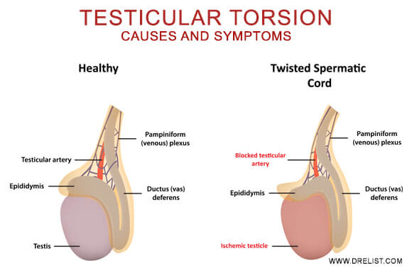 Testicular Torsion: Causes and Symptoms