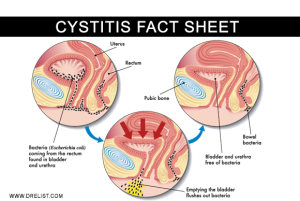 Cystitis Fact Sheet image