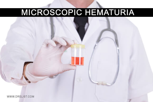 Microscopic Hematuria