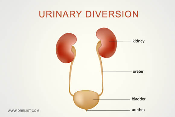 Urinary Diversion