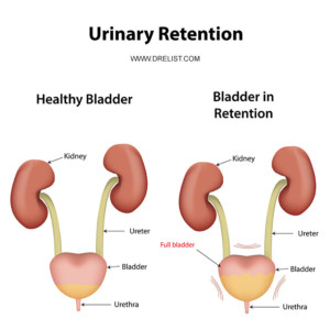 Urinary Retention Image