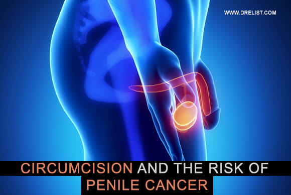 Circumcision And The Risk Of Penile Cancer