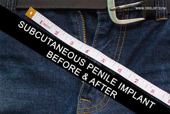 Penuma Subcutaneous Penile Implant Before & After